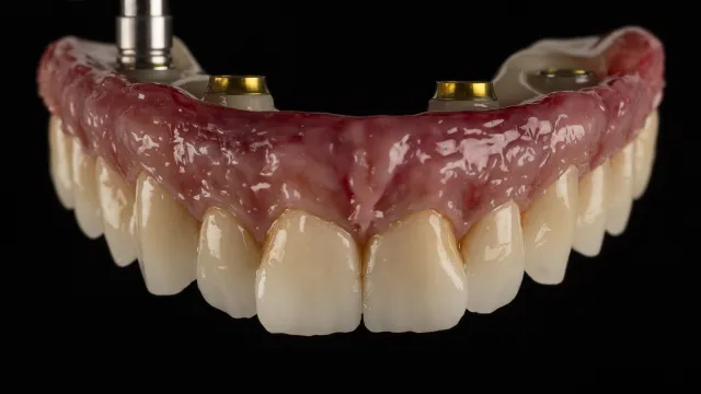 Alta estética sin límites sobre Titanio Aurora®: estratificación total